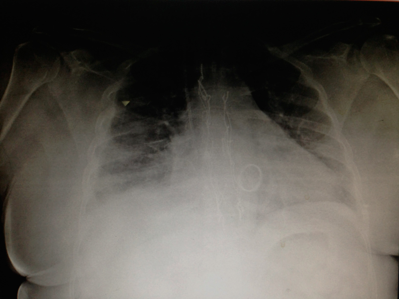 radiografía de tórax